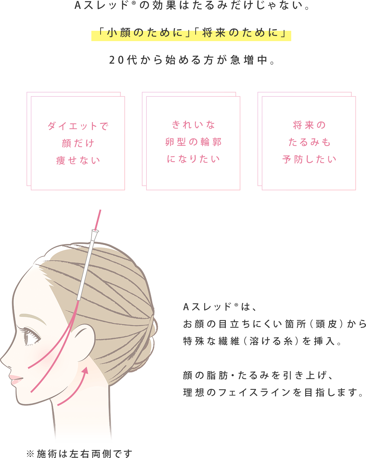 Aスレッド®は、お顔の目立ちにくい箇所（頭皮）から特殊な繊維（溶ける糸）を挿入。顔のたるみを引き上げて輪郭を整え、理想のフェイスラインを目指します。