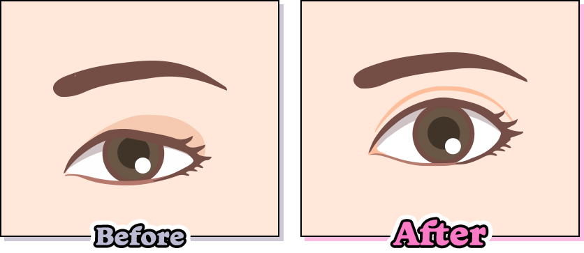 目と眉短縮術（眉下リフト）のbefore/afterの画像