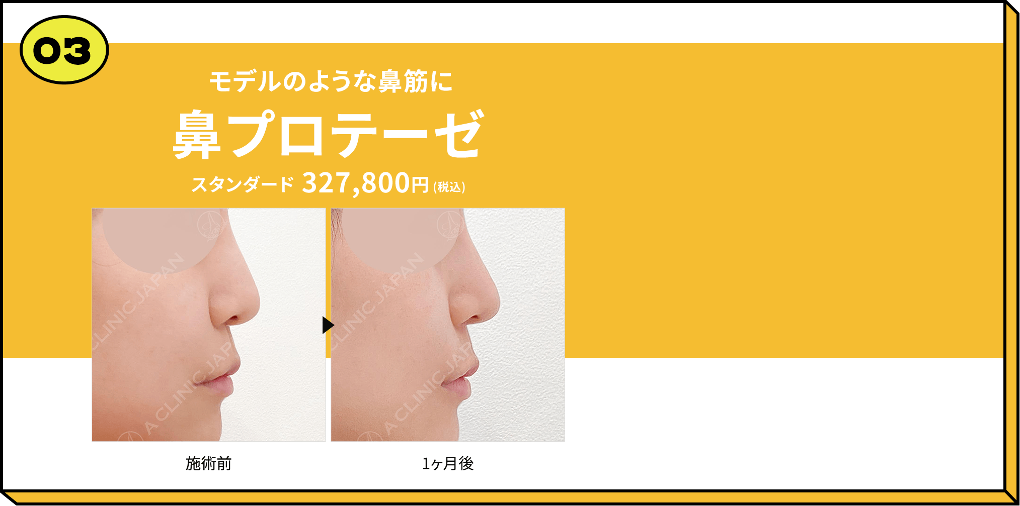 03 モデルのような鼻筋に鼻プロテーゼ