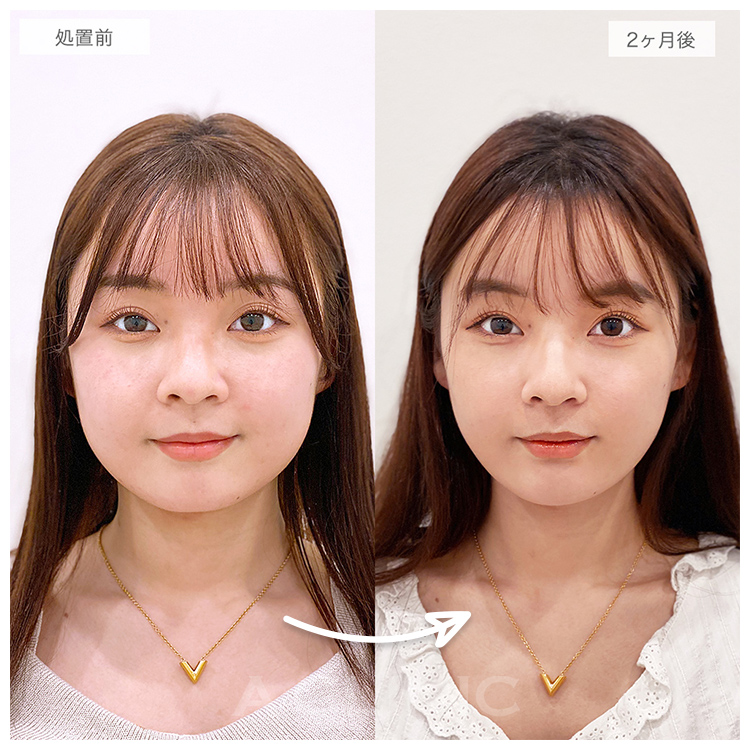 2ヶ月後の症例写真