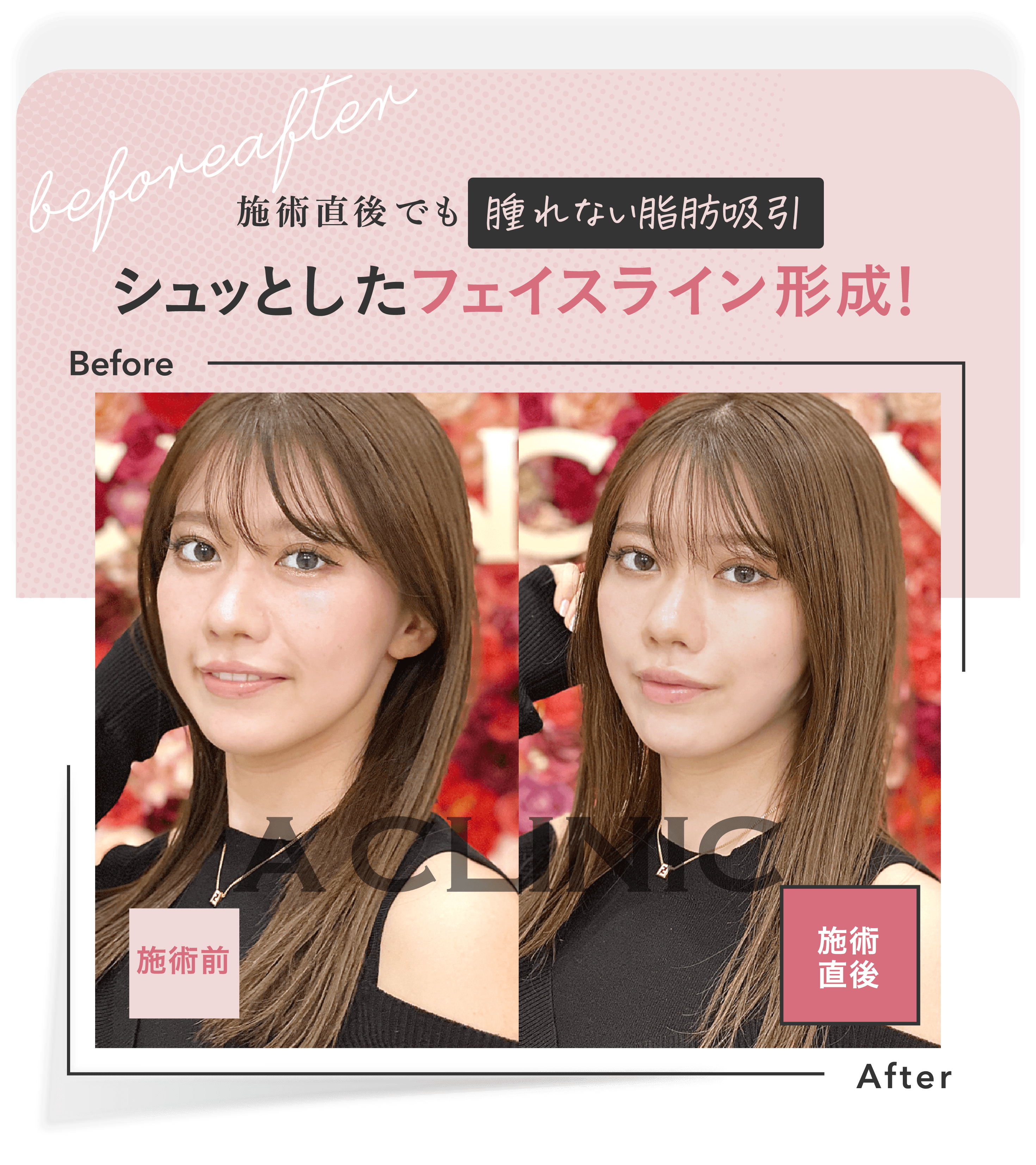 施術直後でも腫れない脂肪吸引 | 施術直後でも 腫れない脂肪吸引