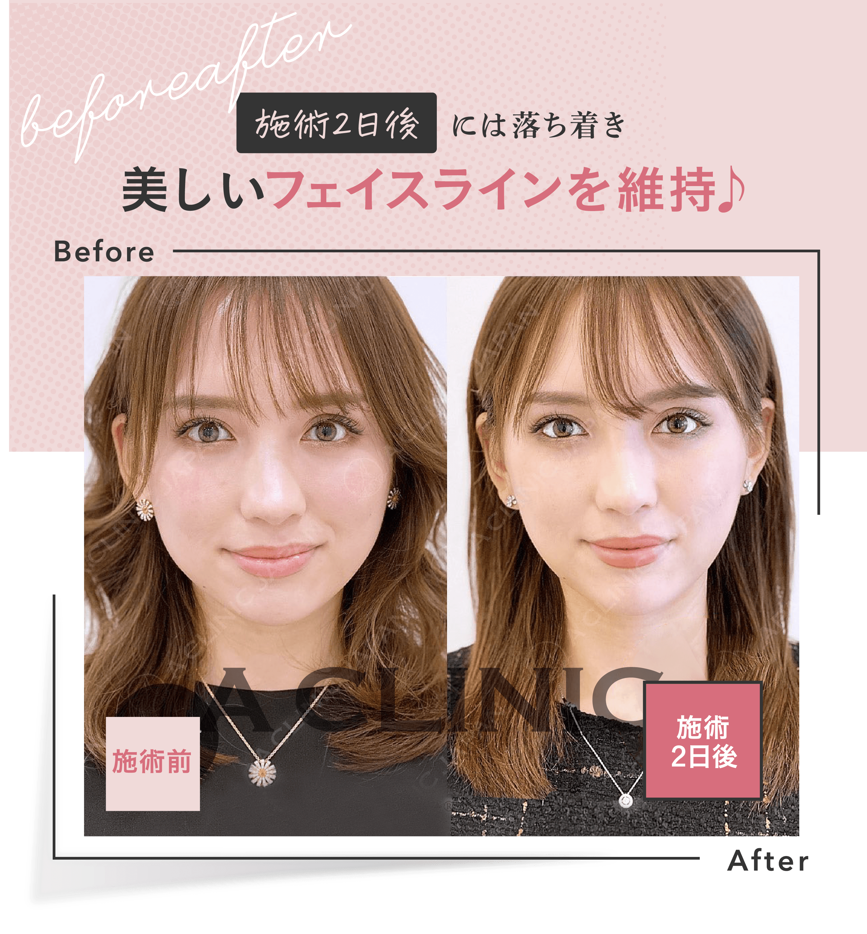 施術2日後には落ち着き | 美しいフェイスラインを維持♪