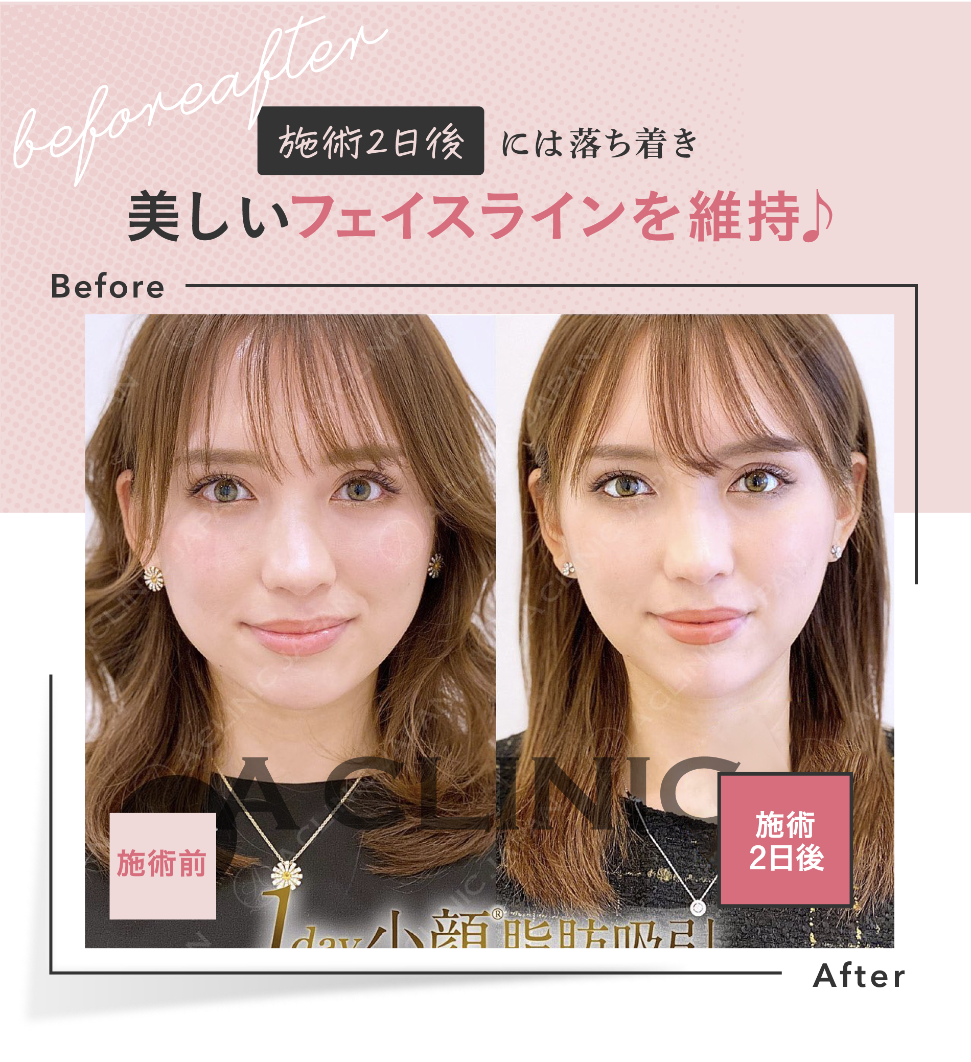 施術2日後には落ち着き | 美しいフェイスラインを維持♪