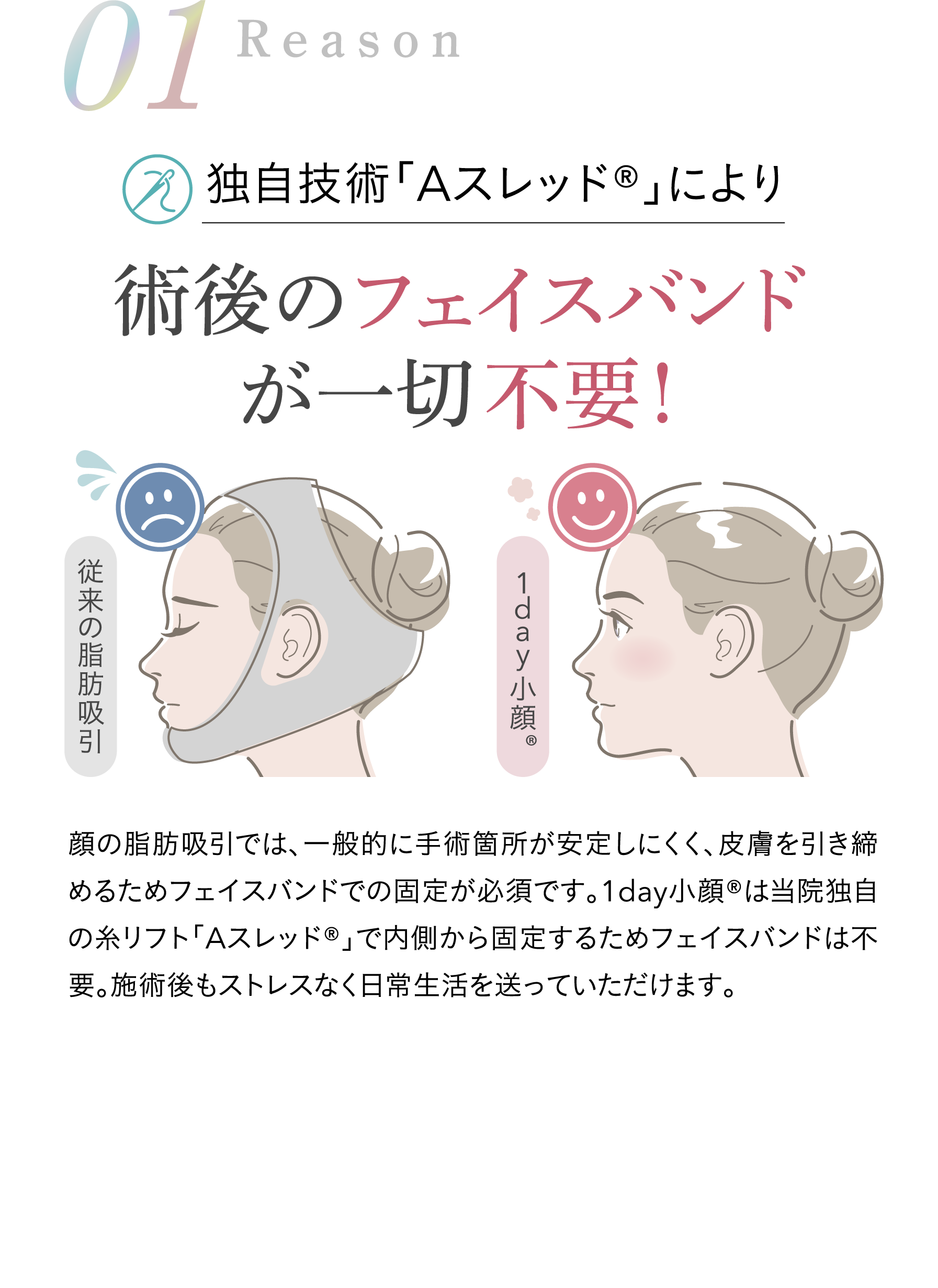 独自技術「Aスレッド®」により術後のフェイスバンドが一切不要！顔の脂肪吸引では、一般的に手術箇所が安定しにくく、皮膚を引き締めるためフェイスバンドでの固定が必須です。1day小顔®は当院独自の糸リフト「Aスレッド®」で内側から固定するためフェイスバンドは不要。施術後もストレスなく日常生活を送っていただけます。