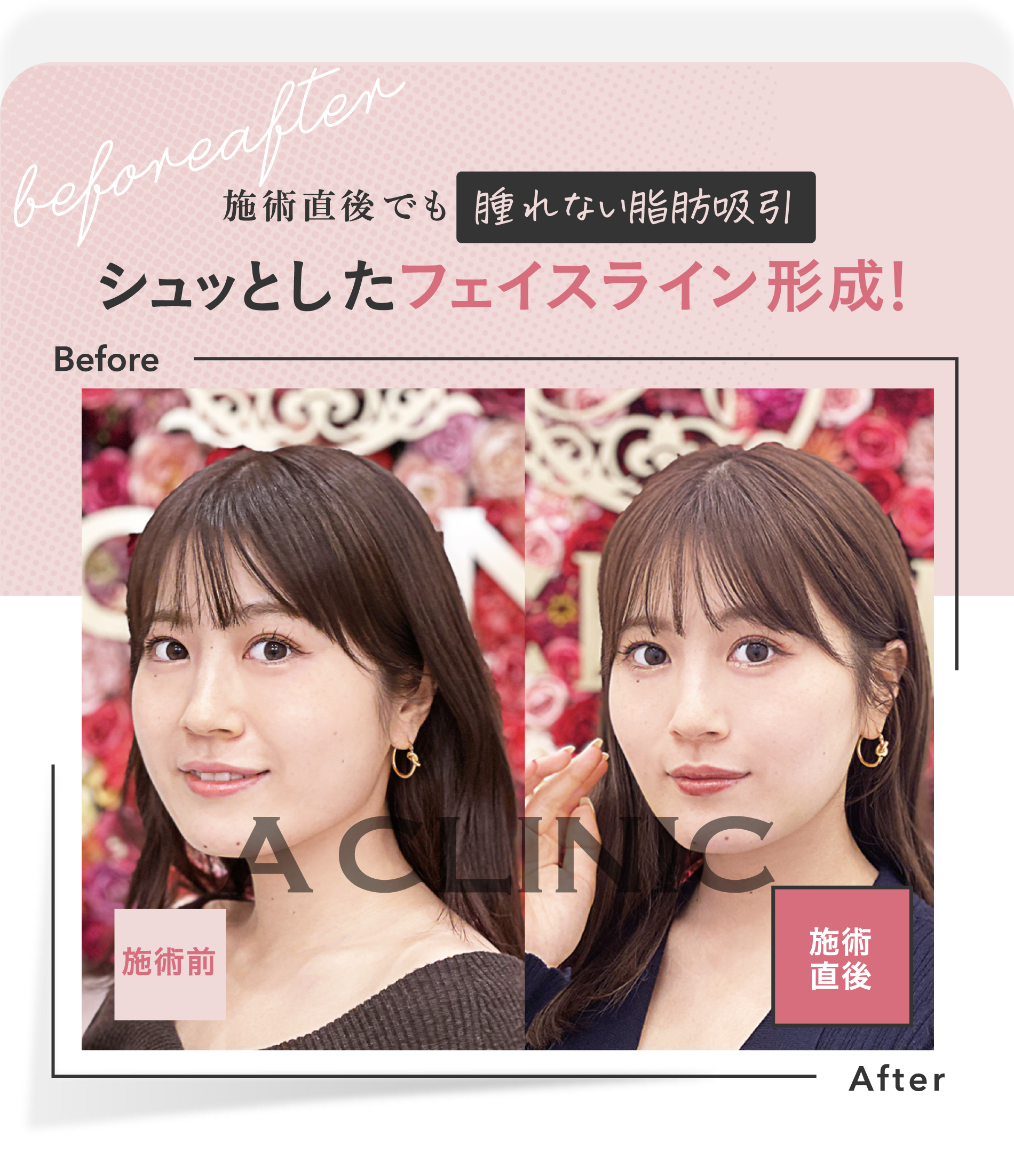 施術直後でも腫れない脂肪吸引 | 施術直後でも 腫れない脂肪吸引