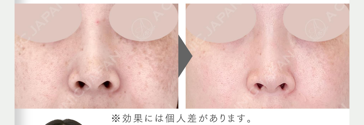 3回目でもこんなに透明感UP ニキビ跡・ハリ不足に効果的