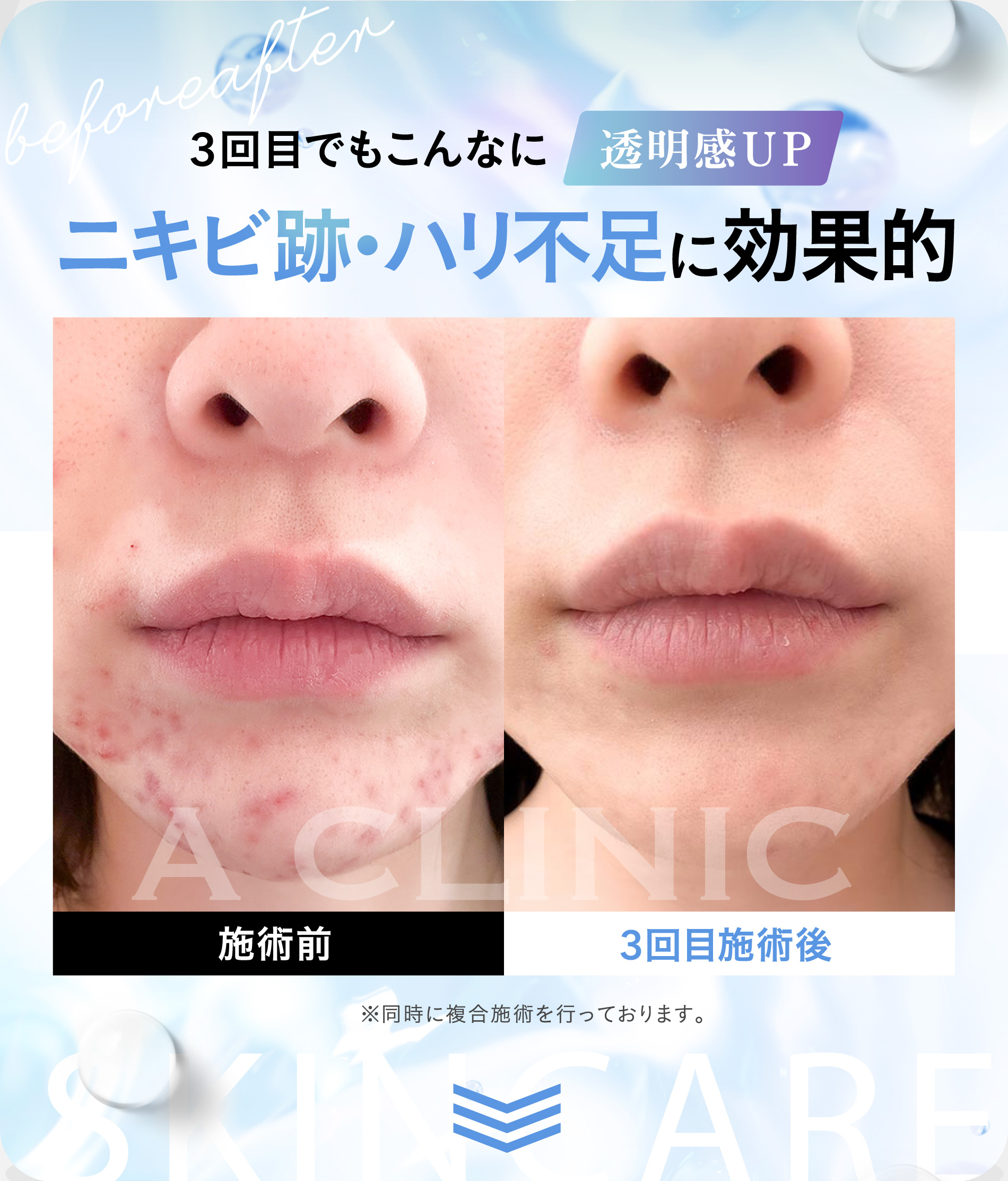 3回目でもこんなに透明感UP ニキビ跡・ハリ不足に効果的