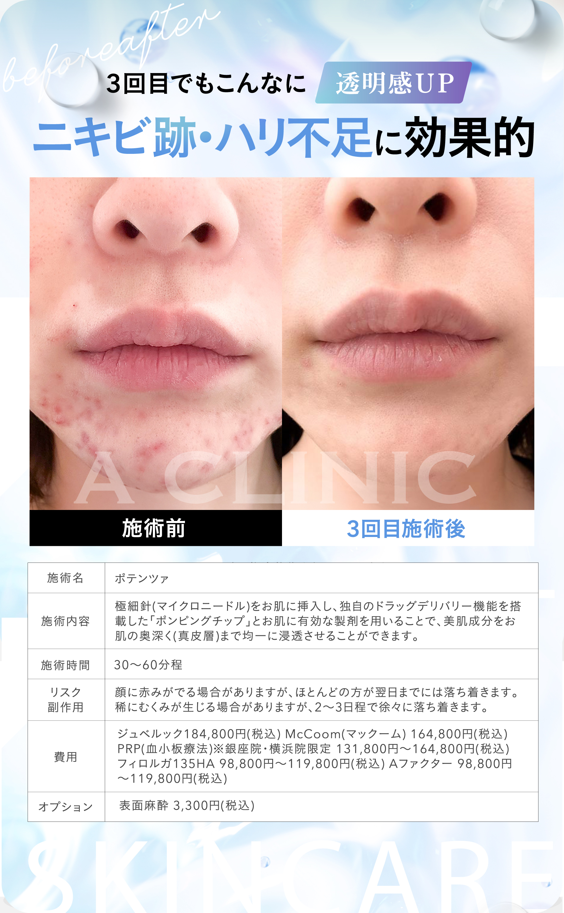 3回目でもこんなに透明感UP ニキビ跡・ハリ不足に効果的