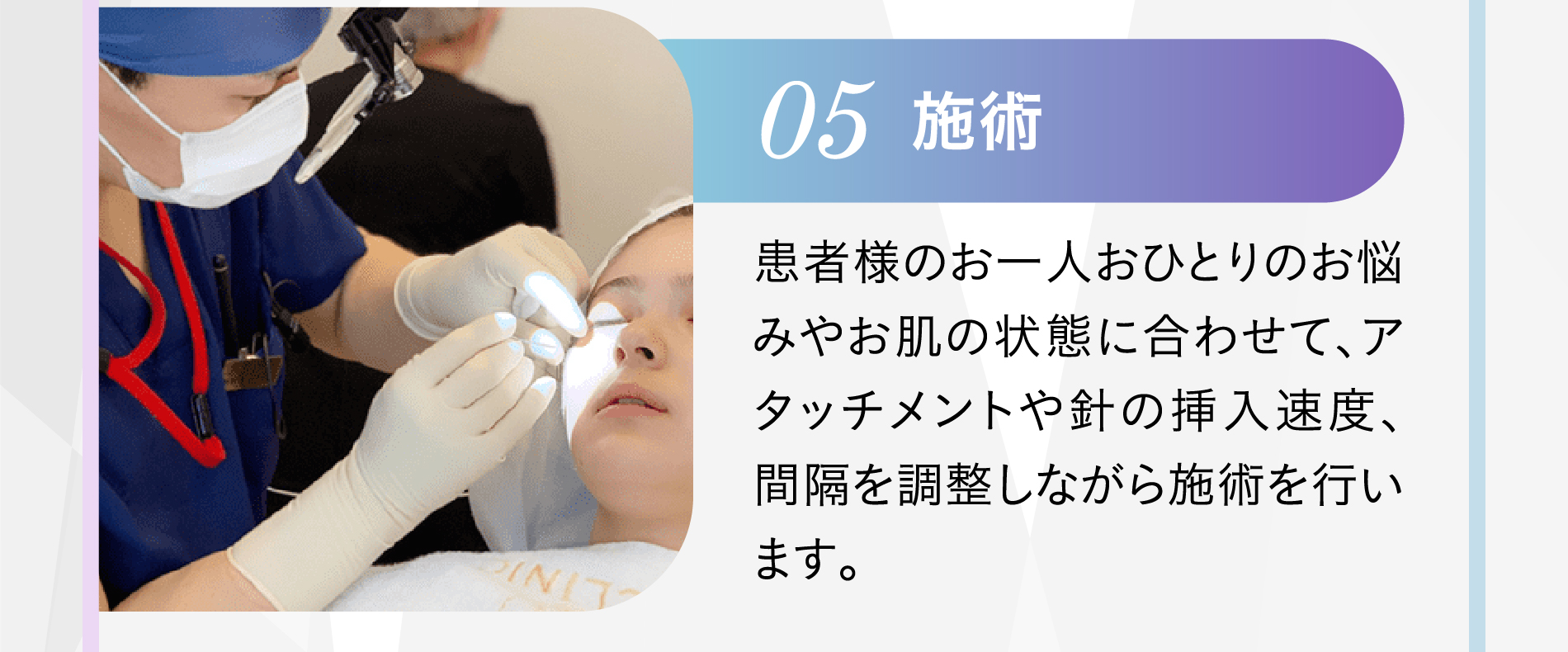 05 施術 患者様のお一人おひとりのお悩みやお肌の状態に合わせて、アタッチメントや針の挿入速度、間隔を調整しながら施術を行います。