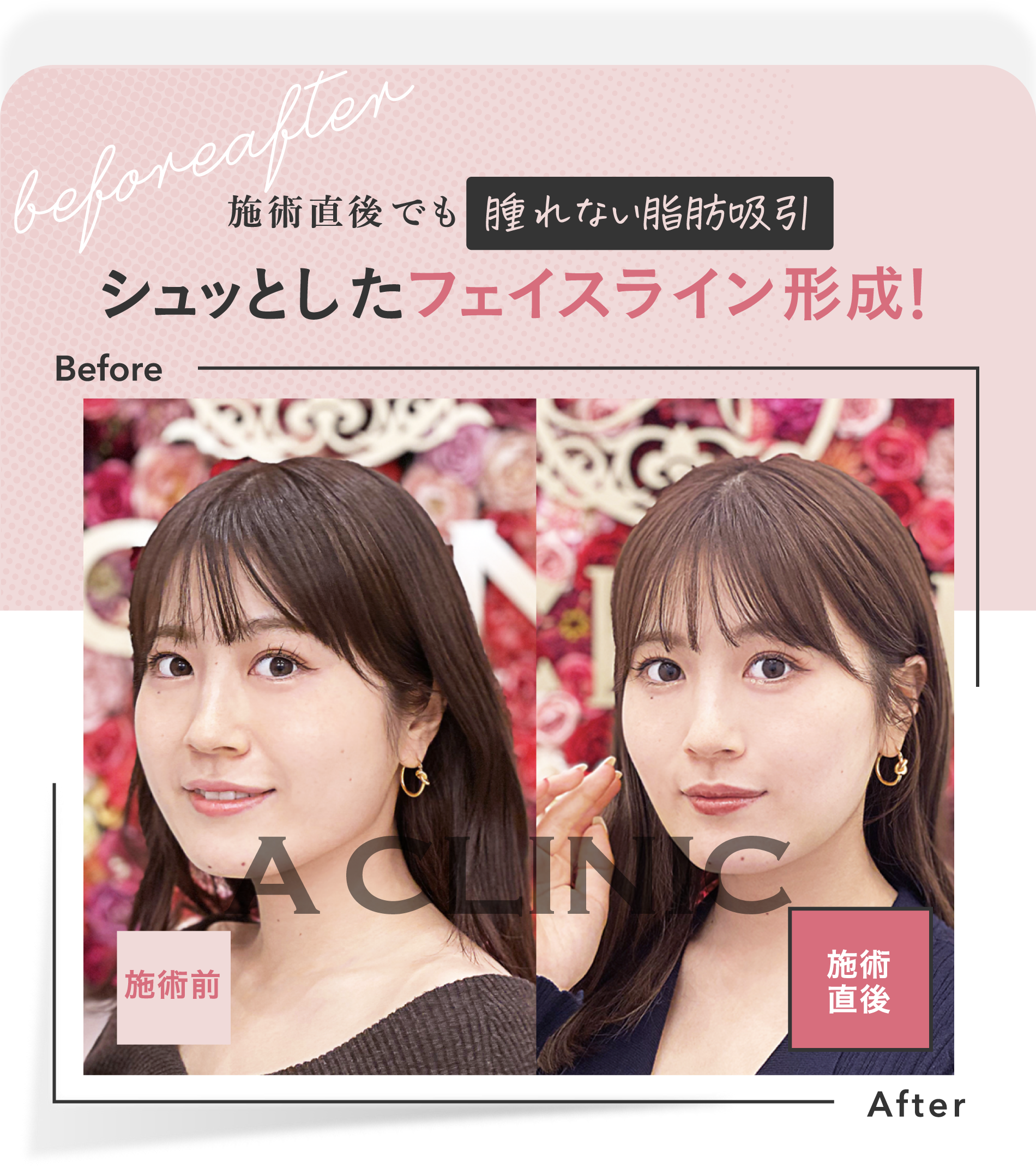 施術直後でも腫れない脂肪吸引 | シュッとしたフェイスライン形成！