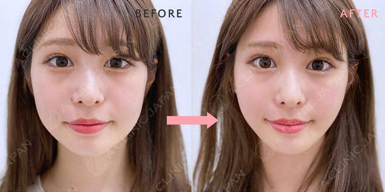 before after