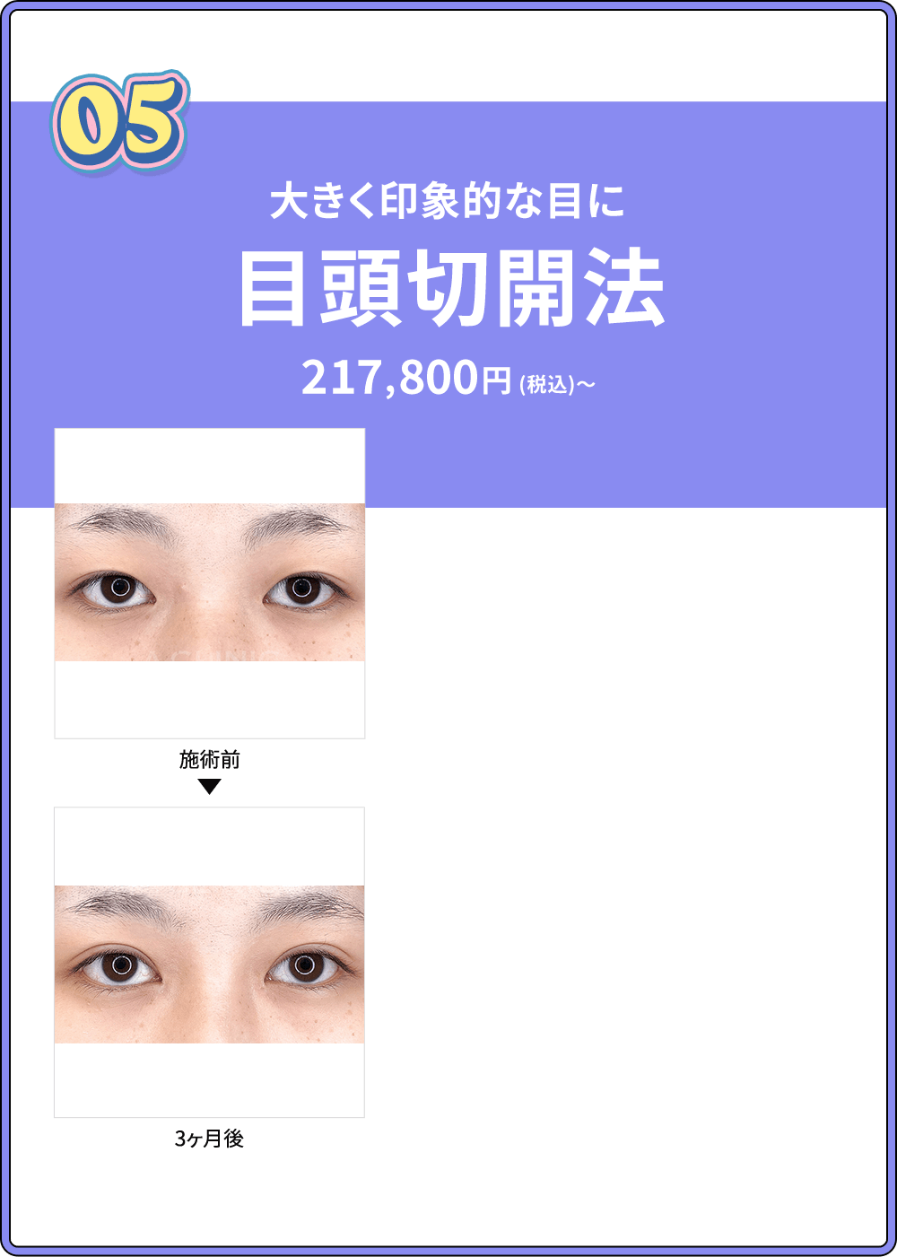 05 大きく印象的な目に 目頭切開法