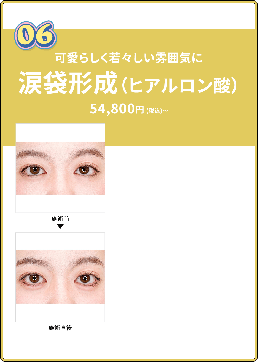 06 可愛らしく若々しい雰囲気に 涙袋形成術（ヒアルロン酸）