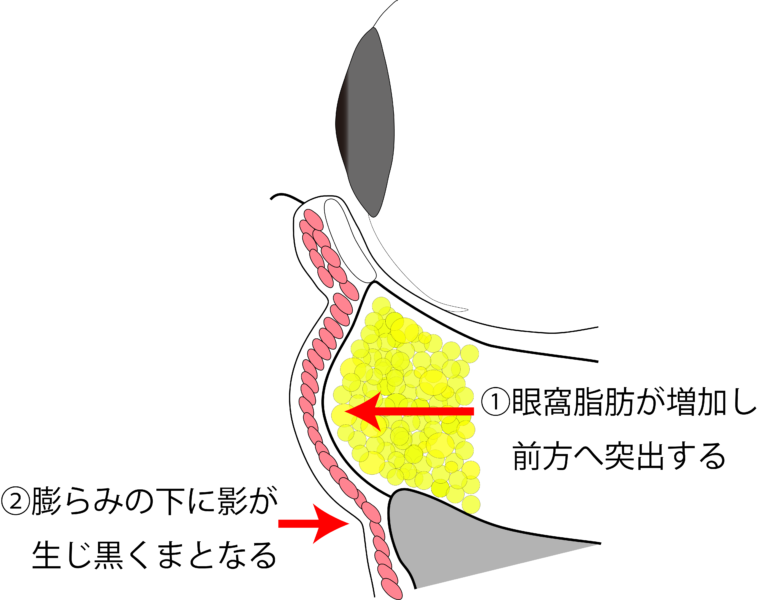 目の下のふくらみ取り施術の流れ