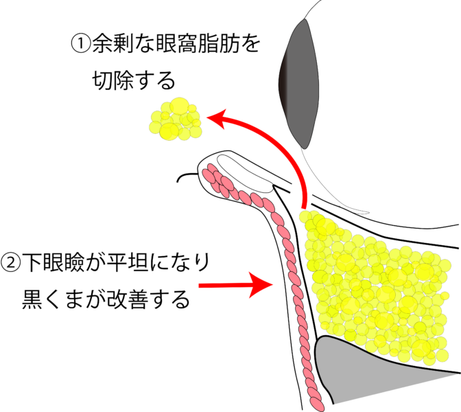 目の下のふくらみ取り施術の流れ