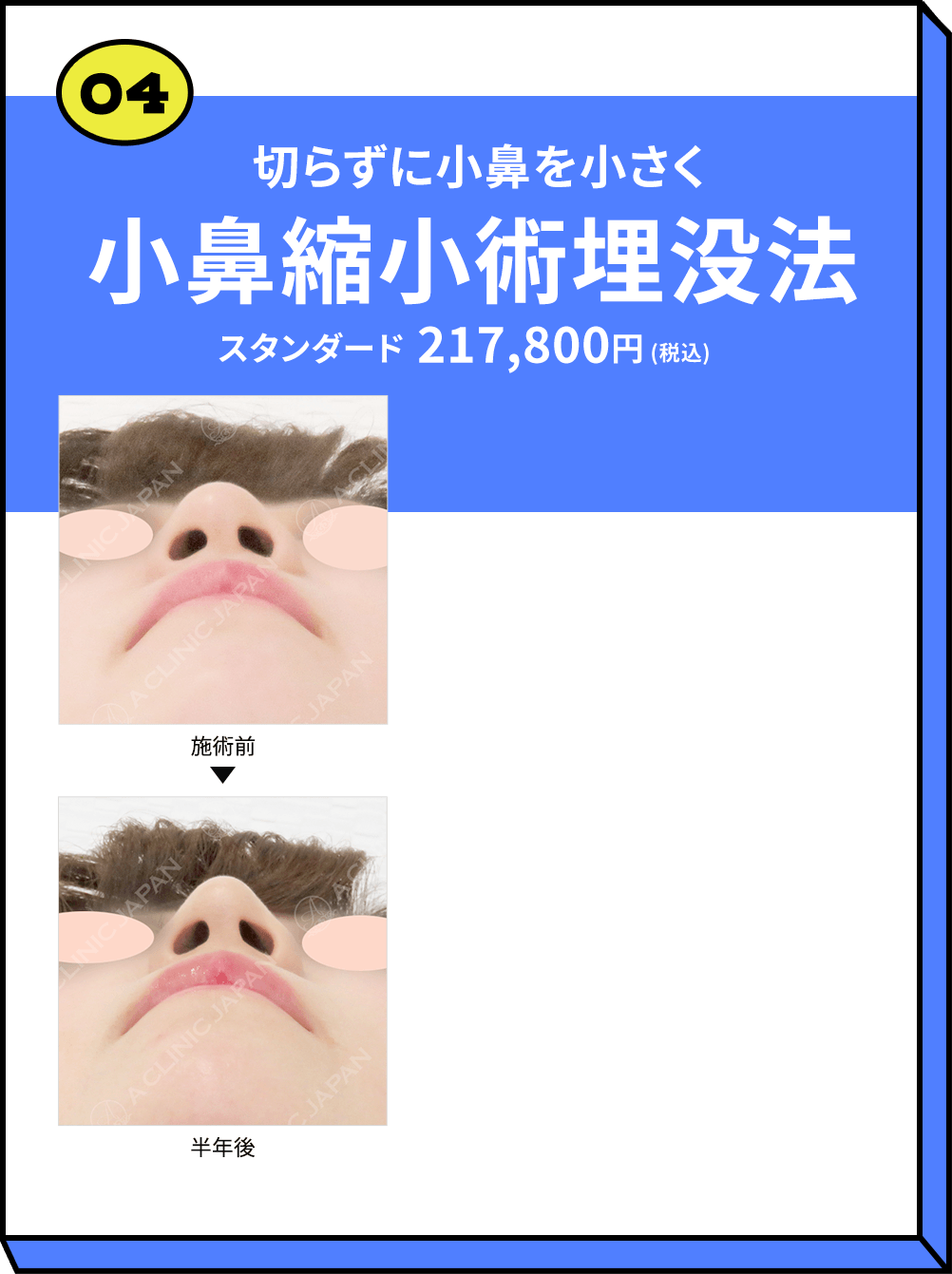 04 切らずに小鼻を小さく 小鼻縮小術埋没法