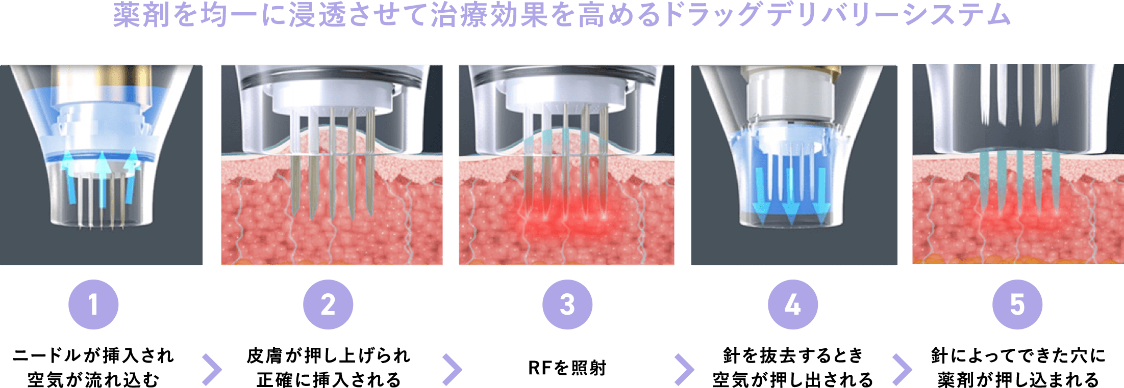 ポテンツァ治療イメージ